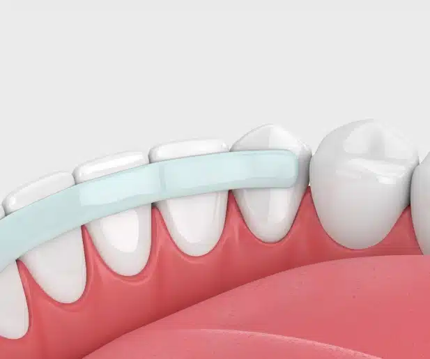 dental bonding service in covina, ca