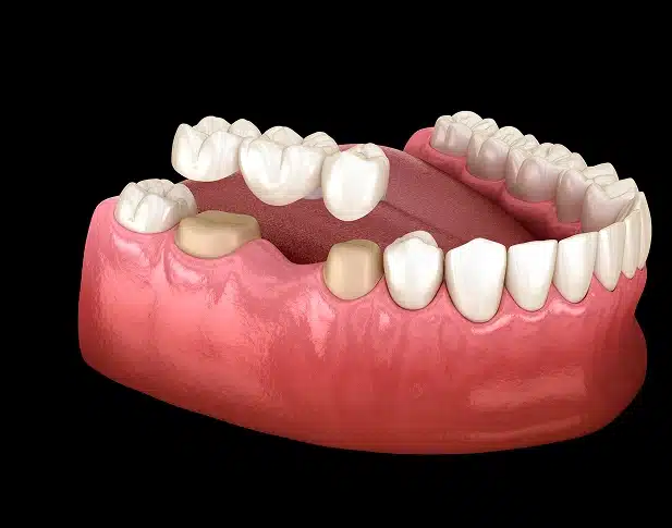 dental bridges in covina, ca