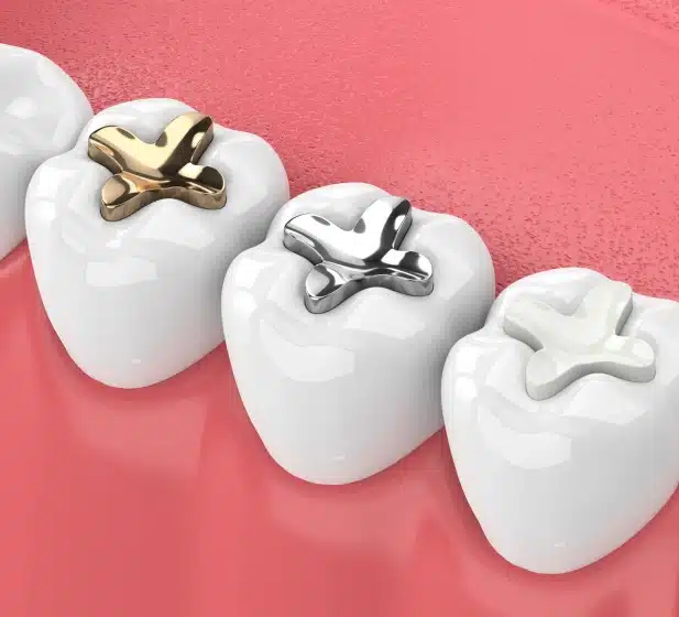dental filling in covina, ca