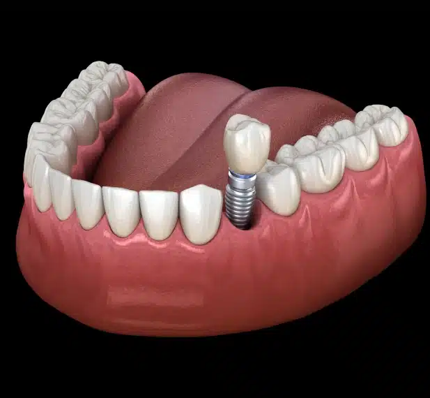 dental implants treatment in covina, ca
