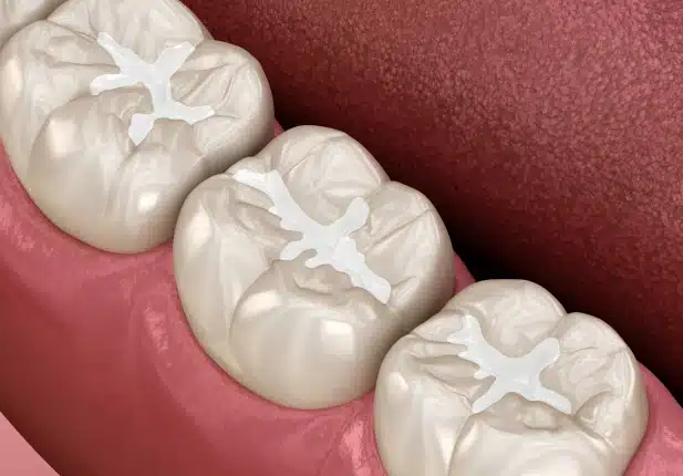 dental sealants service in covina, ca