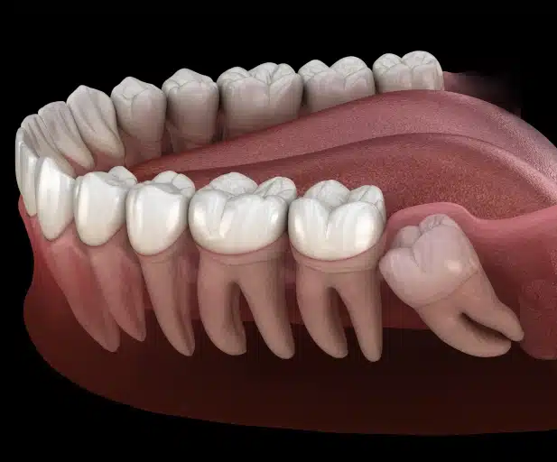wisdom tooth extractions in covina, ca
